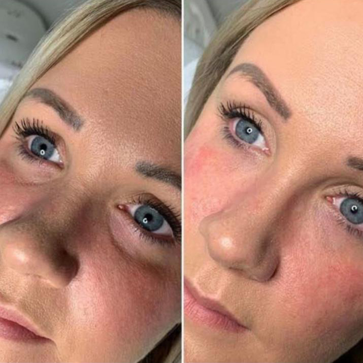 Tear trough dermal filler treatment