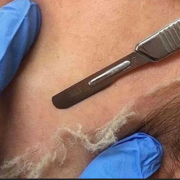 derma