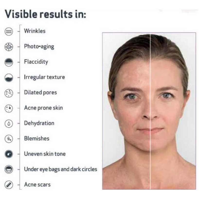 skin micro needling_